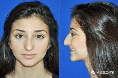 伊朗人鼻子也长这样，伊朗女性通常会做手术把隆起部分削掉